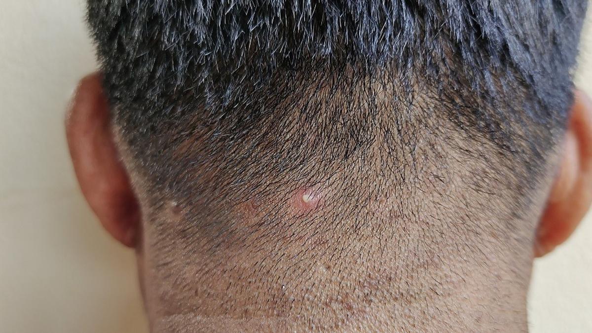 szampon na ropne wypryski na skórze głowy forum