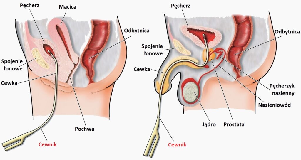 czy cewnik i pampers można używać jednocześnie