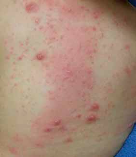 alergiczne podrażnienie narzadu od pieluchy