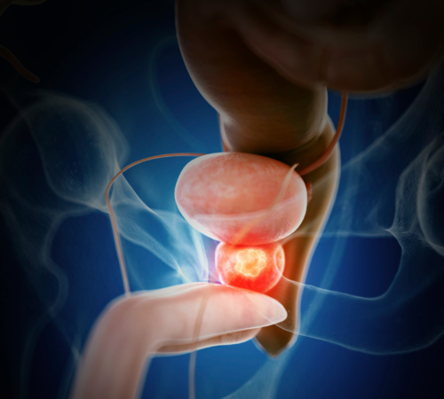 pieluchomajtki po operacji prostaty