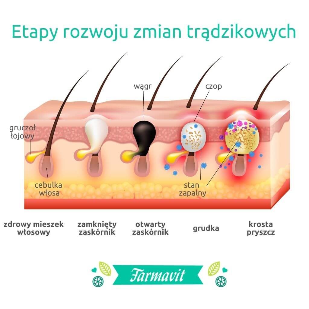 w przypadku skłonności do trądziku konieczna jest właściwa pielęgnacja skóry